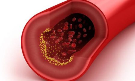 vaso sanguineo con colesterol