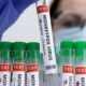 Florida dispone de 25.000 dosis de vacunas contra la viruela del mono